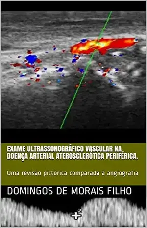Exame ultrassonográfico vascular na doença arterial aterosclerótica periférica.: Uma revisão pictórica comparada à angiografia – Domingos de Morais Filho