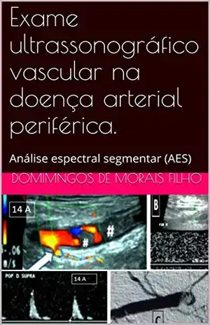 Exame ultrassonográfico vascular na doença arterial periférica.: Análise espectral segmentar (AES) – Domingos de Morais Filho