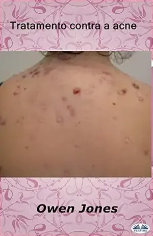 Tratamento contra a acne – Owen Jones